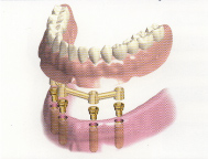 インプラントを使用した半固定式の総入れ歯